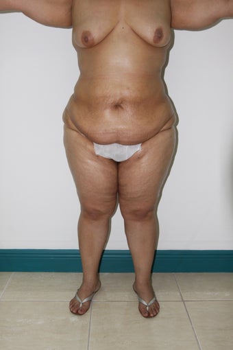 Brazilian Butt Lift 514684