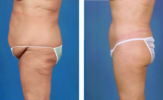 Lower body lift and tummy tuck post gastric bypass surgery - age 57 after 6813