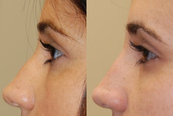 Non-Surgical Rhinoplasty with Silikon-1000 for a profile-bump before 287761