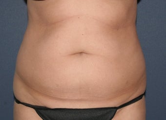 Liposculpture 486595