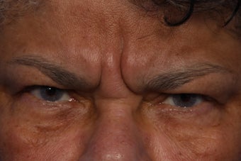 Radiesse and Dysport to Glabella before 308305