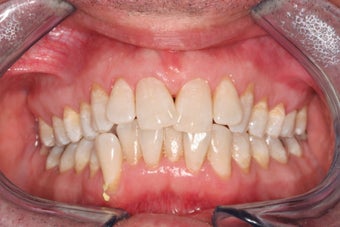 Invisalign before 372594