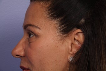 Eyelid Surgery after 306428