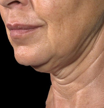 Ulthera Laser Skin Tightening before 346274