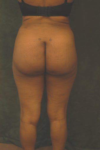 Women's Buttocks Augmentation 518126
