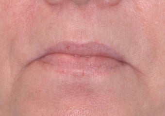 Radiesse and Restylane for Marionette Lines and Lips before 53016