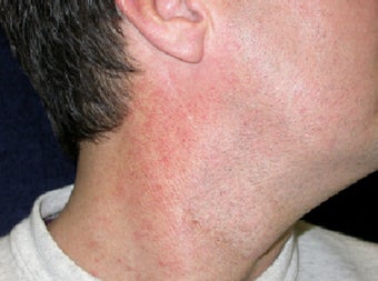 VBeam treatment for neck redness before 123283