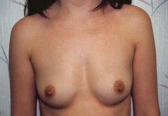 Breast Augmentation before 266790