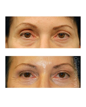 Facial Rejuvenation - Brow Lift after 395967