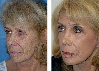 Mini-Facelift, CO2 Laser after 308133