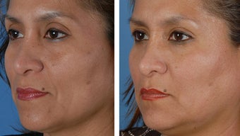 Filler injections to the cheek folds before 253966