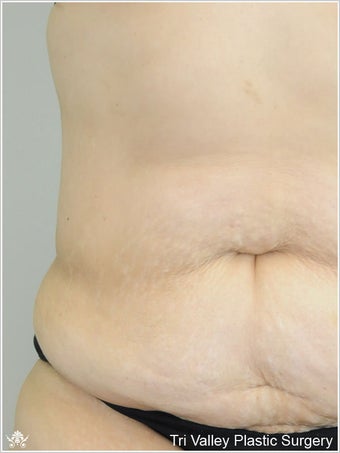 Liposuction before 420933