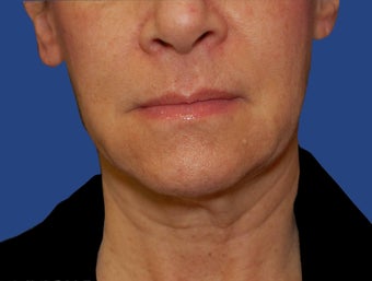 Jawline / Neck Lipo after 565723