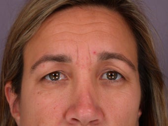 Eyelid Surgery before 306459