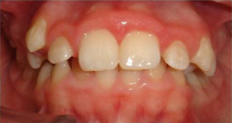 Braces in combination with orthognathic (jaw) surgery before 355264