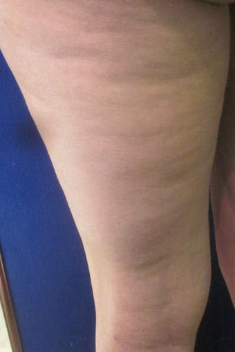Cellulaze before 593042