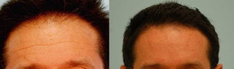 Botox before 138511