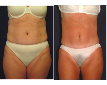 Tummy Tuck / Abdominoplasty before 55012