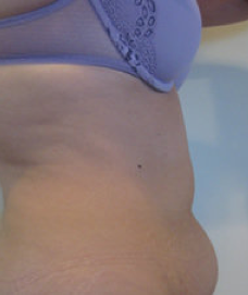 Laser Surgery before 362290
