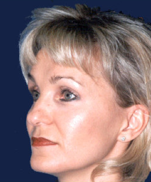 rhinoplasty before 476636
