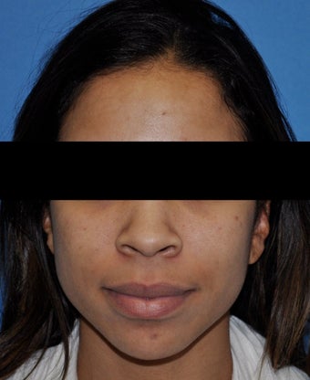 African American Rhinoplasty before 364917