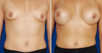 Breast Implants before 494492