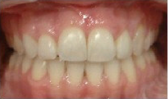 Invisalign Treatment after 359168