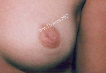 Nipple Surgery before 243244