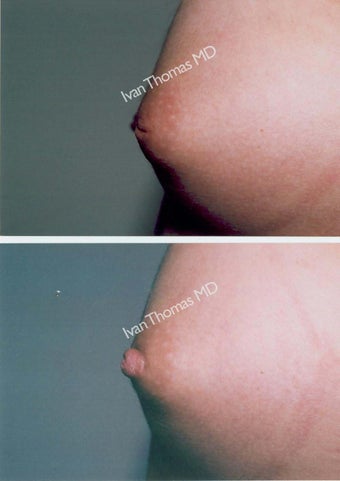 Nipple Surgery before 243248