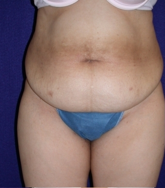 abdominoplasty before 208462