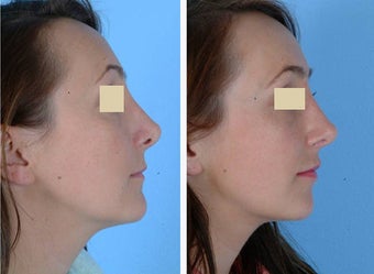 Revision Rhinoplasty before 114212