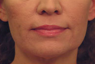 Laser Skin Tightening after 297813