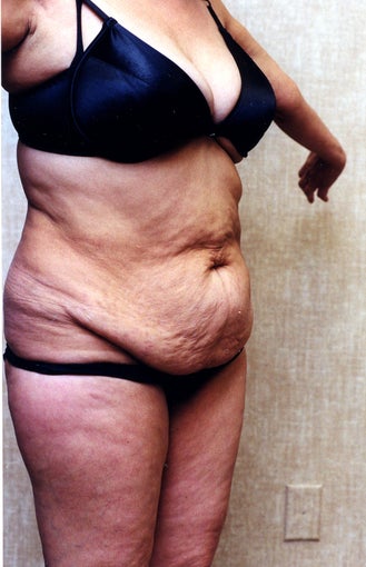 tummy tuck before 304679