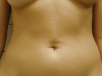 SmartLipo Abdomen 141873