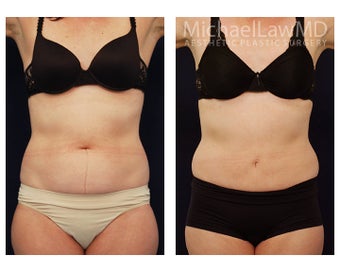 Liposuction before 495519