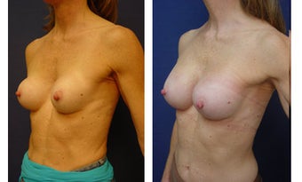 Breast implant correction after 399965