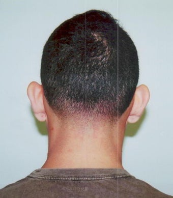 Otoplasty - Bilateral protruding ears before 393546