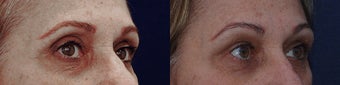 Upper eyelid filler with restylane after 323782