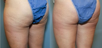 Cellulite Treatment Formula C9 before 641507