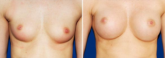 Breast Implants before 494487