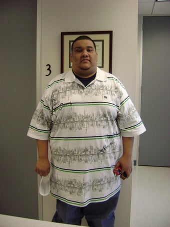 Gastric Bypass before 217188