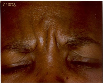 Botox before 469311