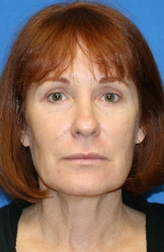 2 years post op: Facelift, Lower Eyelid Skin Pinch, and Peri-orbital Fat Transfer before 424184