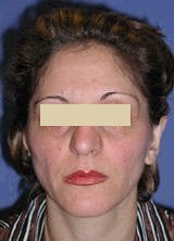 Ear Surgery (Otoplasty) after 146590