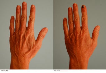 Hand Fat Grafting before 222734