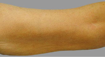 Exilis after 424062