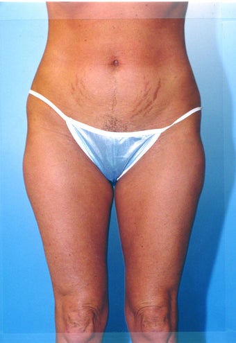 liposuction of thighs for women 583572