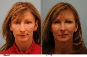 Full Face Fat Transfer before 436478