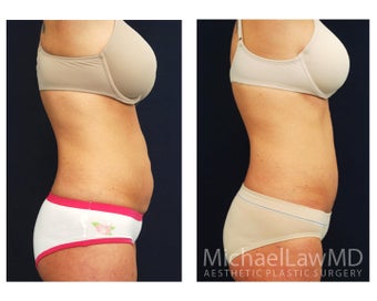 Abdominoplasty - Tummy Tuck 396097