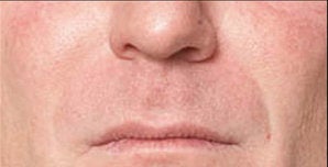 Restylane® after 388348